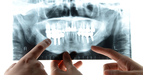 インプラント治療　手術と工程 | 歯のレントゲン写真と手