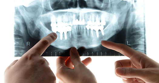 インプラント治療　手術と工程 |  歯のレントゲン写真と手
